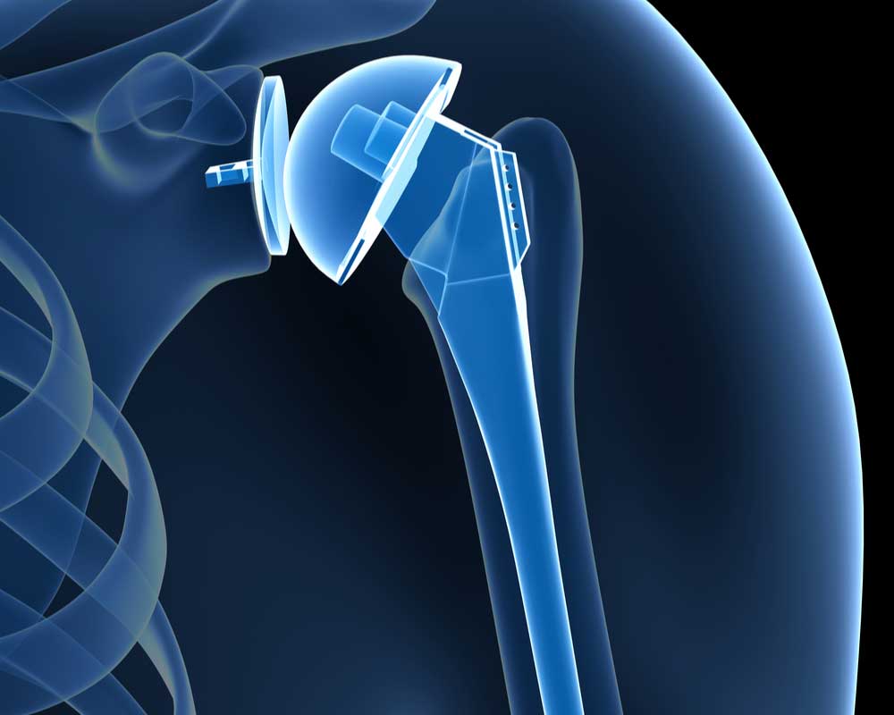 Is a shoulder replacement a major operation?