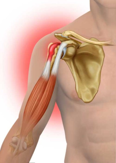 Biceps Tendon Injury