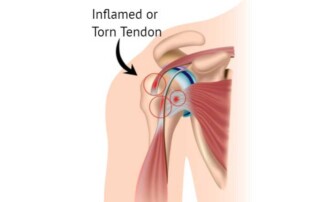 Inflamed or torn biceps tendon