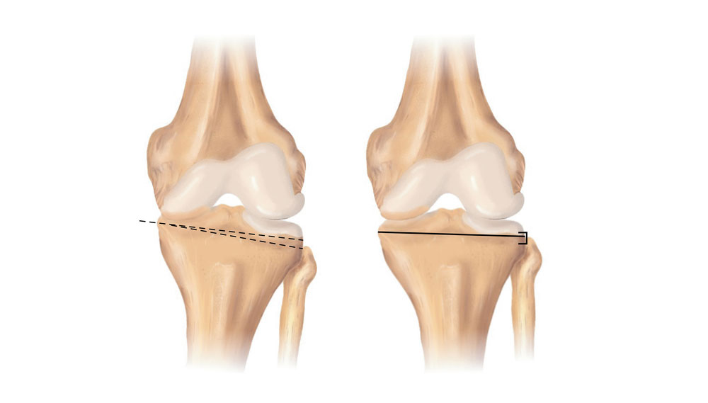 knee-osteotomy-knee-surgeon-van-nuys-westlake-village-los-angeles-ca