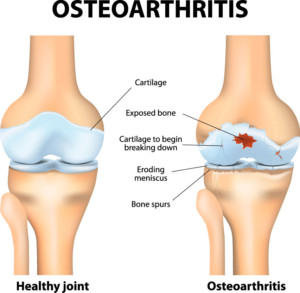 Osteoarthritis Knee Injury | Articular Cartilage Damage