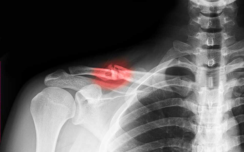 Shoulder Fracture | Shoulder Specialist | Van Nuys, Westlake Village ...